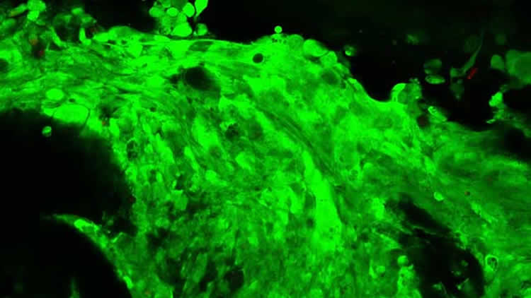 Image shows a brain tumor.