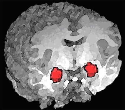 The image shows the position of the amygdala in the brain.