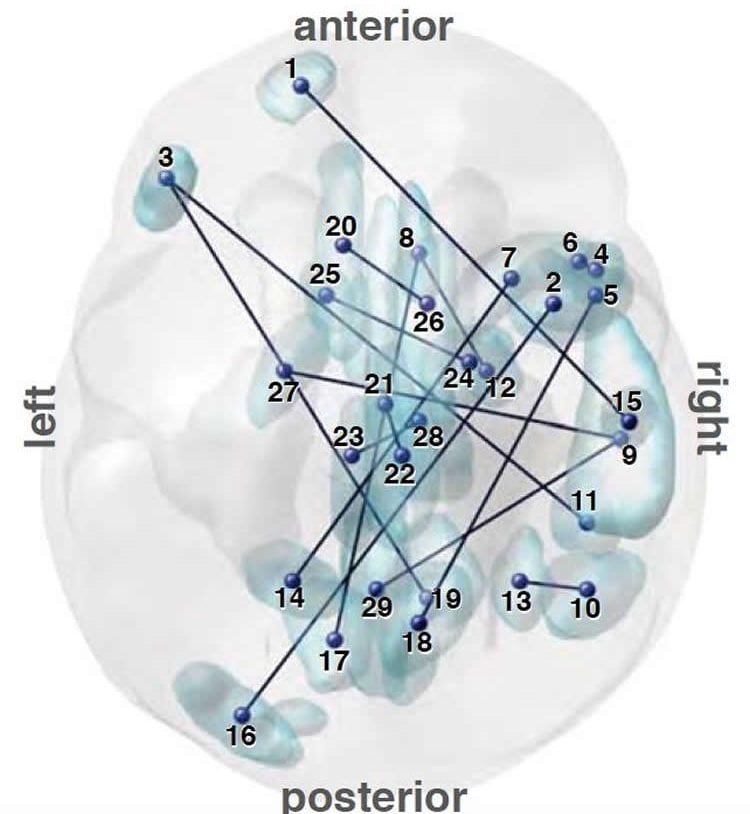 Image of a brain with connection points for autism diagnosis.