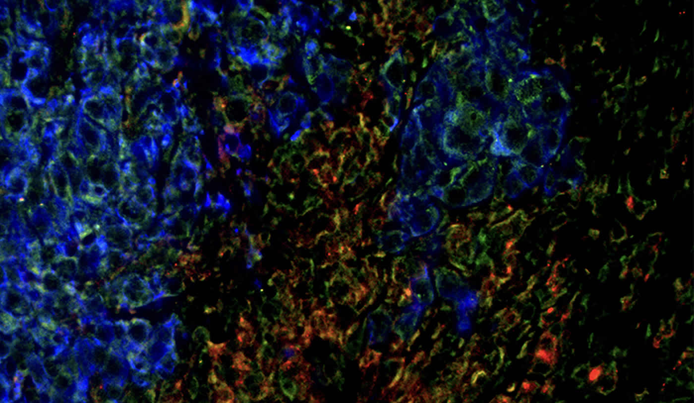 This shows brain cancer cells