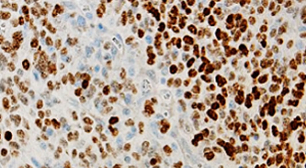 This shows DIPG cancer cells