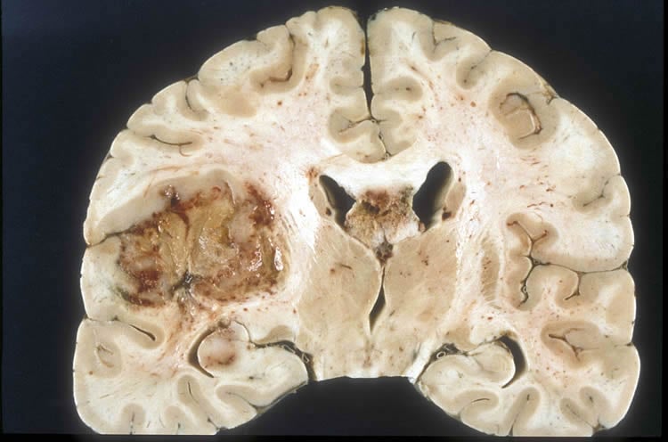 a brain slice from a patient with glioblastoma brain cancer