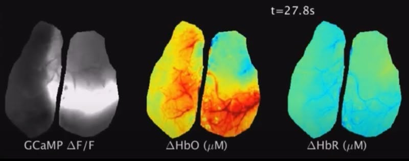 This shows stills from the video of the glioma blood flow