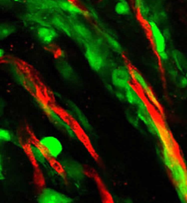 The image shows glioma cells.