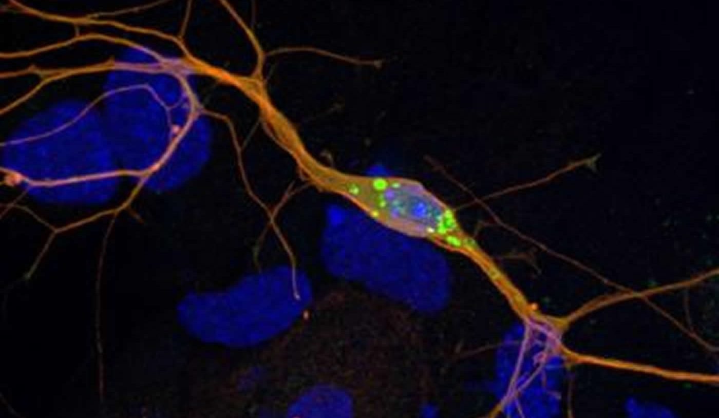 Image shows Lewy bodies.