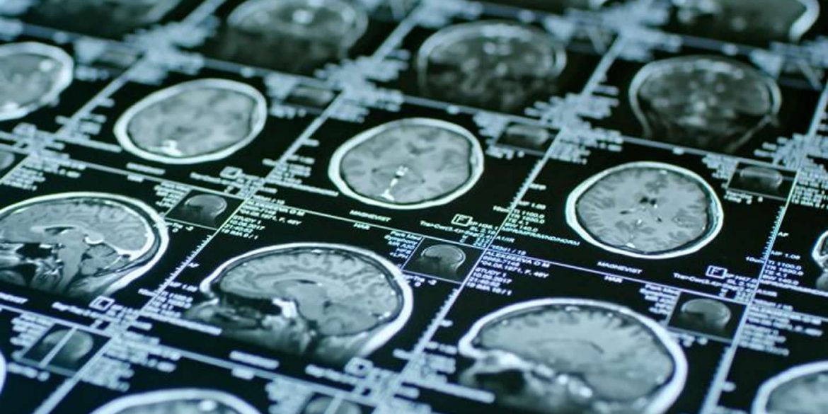 This shows brain scans