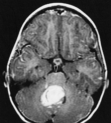 This image is an MRI scan of a medulloblastoma brain tumor.