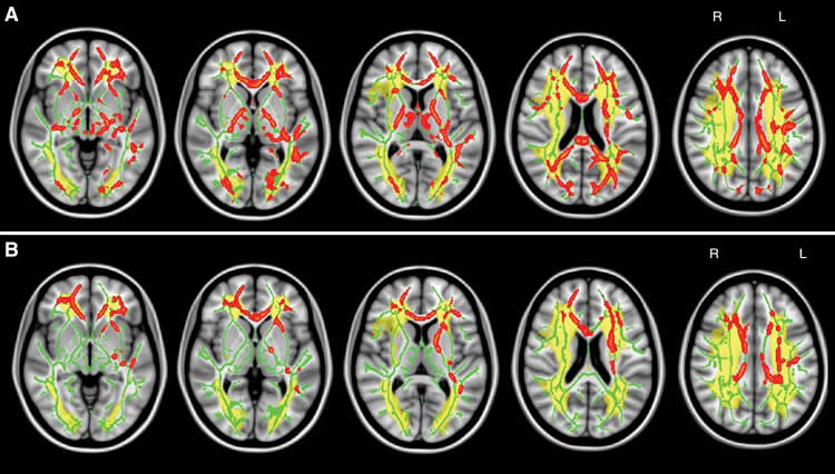 Image shows brain scans of white matter.