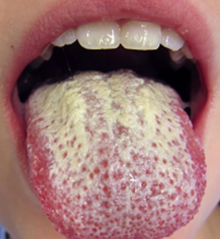 Photo of a person with an oral Candida infection.